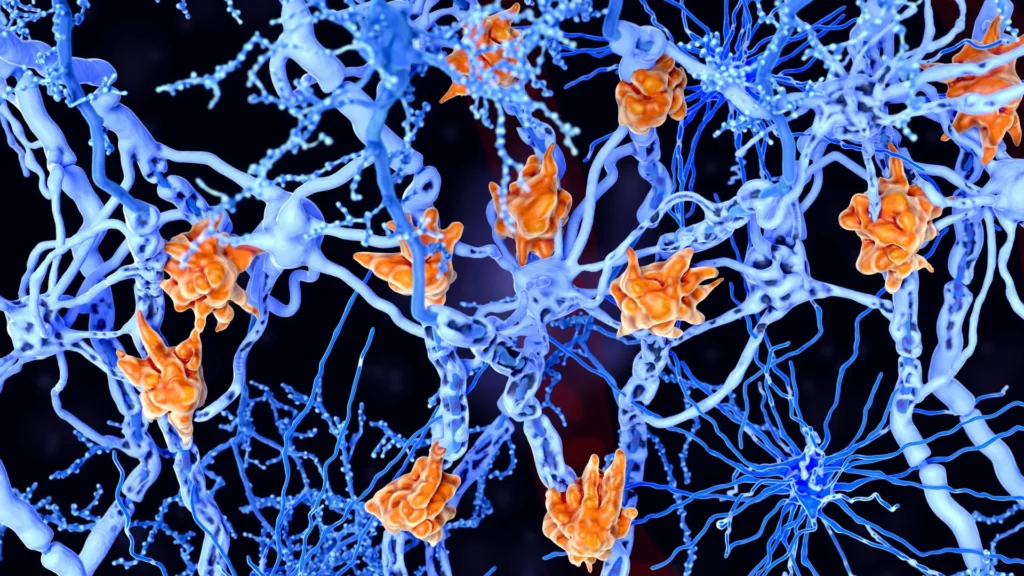 These fat-filled brain cells may be making multiple sclerosis worse