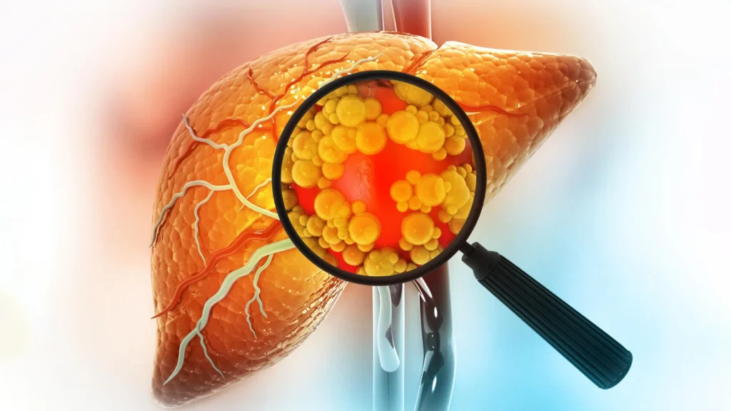 Experimental drug reverses severe fatty liver disease by repairing the gut