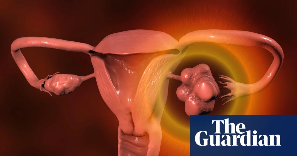 Women with irregular periods should be checked for PMOS, NHS says | Health
