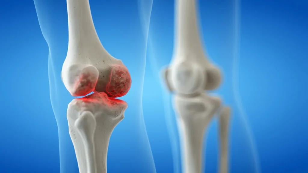 Knee osteoarthritis isn’t inevitable — here’s what you can do
