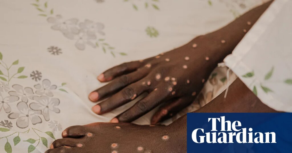 Mpox is back – and in new countries. How can this outbreak be contained? | Global health