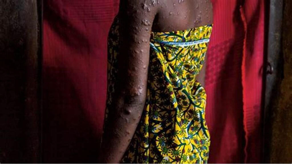 11 African countries record 1,153 mpox cases in six weeks 11 African countries record 1,153 mpox cases in six weeks
