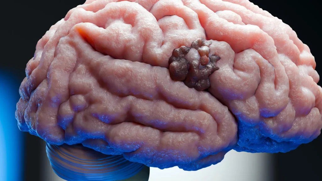 Scientists find a weak spot in one of the deadliest brain cancers Scientists find a weak spot in one of the deadliest brain cancers