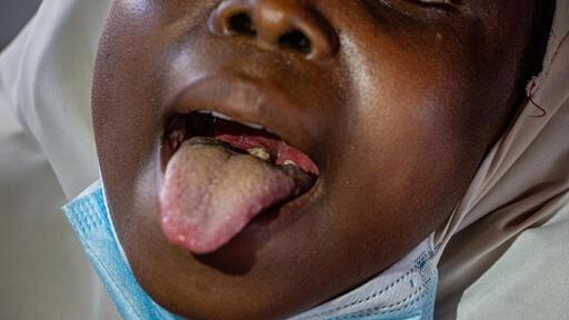Taraba begins tetanus-diphtheria vaccination for women Taraba begins tetanus-diphtheria vaccination for women