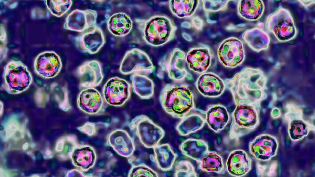 Unvaccinated Pennsylvania woman died of measles complications, coroner says Unvaccinated Pennsylvania woman died of measles complications, coroner says